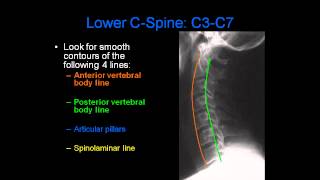 Radiology of Spine Trauma [upl. by Loftis]