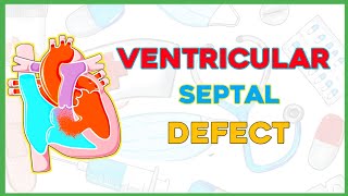 Ventricular Septal Defect VSD Pathophysiology clinical features diagnosis treatmentpediatrics [upl. by Nanji]