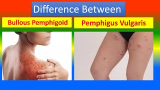 Difference Between Bullous Pemphigoid and Pemphigus Vulgaris [upl. by Januarius674]