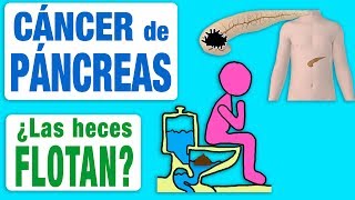 El cáncer de páncreas ¿hace flotar las heces [upl. by Layman]