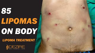 85 Lipomas Removal From Body  Multiple Lipoma Treatment under Local Anesthesia [upl. by Joycelin]