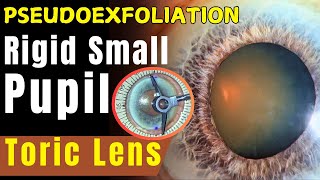 Toric IOL in an eye with pseudoexfoliation and rigid pupil Dr Deepak Megur [upl. by Ecirtam]