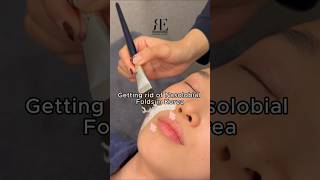 Smile Line Removal ✨ koreanskincareroutine beauty koreanbeauty korea [upl. by Aniled525]