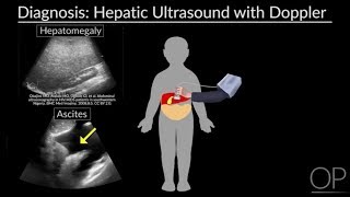 VenoOcclusive Disease by Steven Margossian for OPENPediatrics [upl. by Bumgardner]