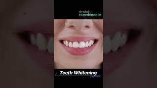 Tooth Cleaning  Teeth Scaling I stain or Tartar Removal cost  Dentalexperiencein [upl. by Rodina]