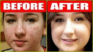 How To Remove Pimples Overnight With Just 1 Product  Acne Treatment  RABIA SKIN CARE [upl. by Petronilla911]