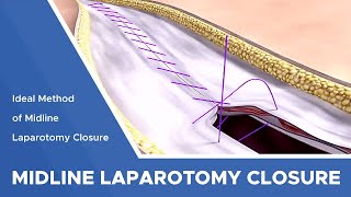 Principles of Abdominal Wall Closure Abdominal Closure Technique [upl. by Horne]