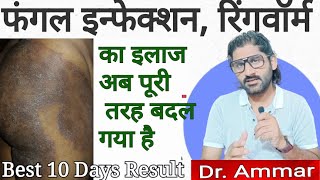 Fungal infection ka treatment ab puri tarah badal gaya hai Best treatment for fungal amp Ringworm [upl. by Gnivri417]