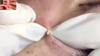 TONS of Blackhead Whitehead amp Pimple Extractions on Forehead amp Eyebrows [upl. by Snyder94]