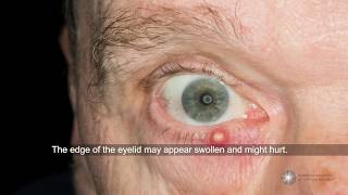 Are styes contagious and what can I do about them  Ask an Ophthalmologist [upl. by Corell]