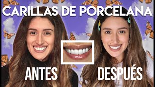 Carillas Dentales de Porcelana Antes y Después Mi Experiencia Paso a Paso y Más [upl. by Ettedo]