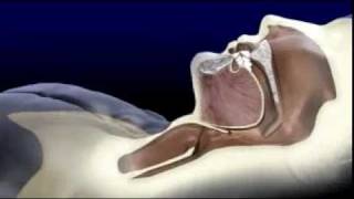 Sleep Apnea Explained By ORA Oral Surgery Sleep Disorder amp Implant Studio [upl. by Gean]