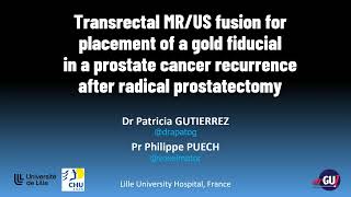 MRUS fusion for placement of a fiducial in a prostate cancer recurrence after prostatectomy [upl. by Sitarski]