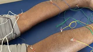 sciatica pain Acupuncture Treatment Karimnagar [upl. by Ariaj]