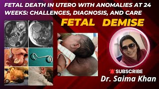 Fetal Death in Utero with Anomalies at 24 Weeks Challenges Diagnosis and Care drsaima khan case [upl. by Immas]