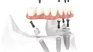 Dental Implant Osseointegration Process [upl. by Ellehsal]