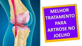 ARTROSE NO JOELHO TRATAMENTO DE FISIOTERAPIA Clínica Dr Robson Sitta [upl. by Aleek]