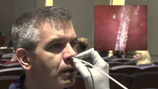 nasopharyngeal laryngoscopy Original [upl. by Clyde]