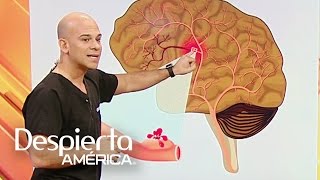 ¿Cómo detectar las señales de un aneurisma cerebral [upl. by Viridi]