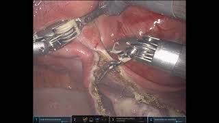 Minimally invasive davinci Robotic TLH with Ovarian suspension [upl. by Kleper]