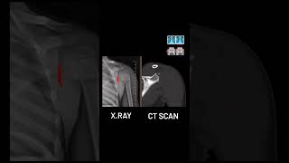 Xray vs ct scan ctscan xray radiology radiography radiologytech doctor motivation viral [upl. by Monarski]