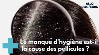 Tout savoir sur les pellicules  AlloDocteurs [upl. by Mota]