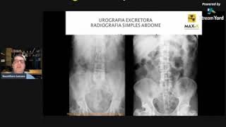 Urografia Excretora  Radiografia Simples do Abdome [upl. by Natsyrt983]