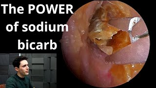 Sodium Bicarbonate Drops VS Earwax amp Dead Skin [upl. by Airretnahs871]