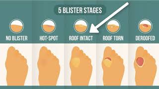 How To Treat A Blister Correctly First Look At Your Blister Roof [upl. by Anyrtak617]