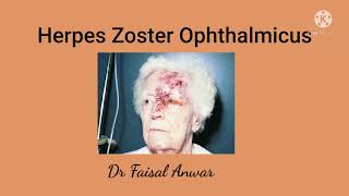 Herpes Zoster Ophthalmicus II Hutchinsons sign II Postherpetic Neuralgia [upl. by Mainis]