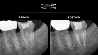 37 I had a root canal at another dentist and Im still in pain [upl. by Eberta]