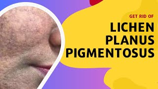 Get Rid of Lichen Planus Pigmentosus [upl. by Estrin]