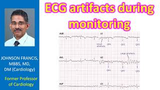 ECG artifacts during monitoring [upl. by Arised]