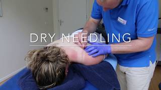 Dry Needling and quotSciaticaquot [upl. by Einneg]