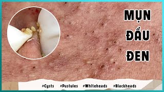 Big Cystic Acne Blackheads Extraction Blackheads amp Milia Whiteheads Removal Pimple Popping [upl. by Ruhl]