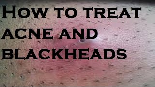 How to treat acne and blackheads [upl. by Lyrpa]