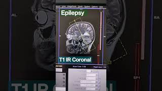 Brain epilepsy protocol planning perpendicular to hippocampus [upl. by Holleran588]