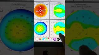 KCN Siblings spectrum of the ectasia and treatment with Athens protocol CXL Kanellopoulos MD ￼ [upl. by Dnama]