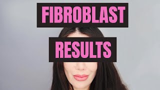 UPDATE 2 Months after fibroblast  FAIL [upl. by Aliac782]