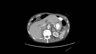 Marginal ulcer perforation Billroth 2 [upl. by Donal]