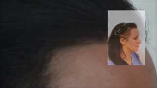 3730 FUT Hattingen Hair Transplantation Switzerland [upl. by Audwen706]