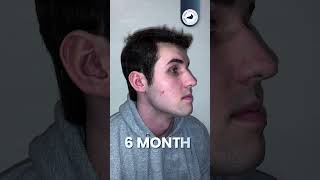 HAIR LOSS BEFORE AND AFTER  12 MONTHS  SMILE HAIR CLINIC [upl. by Atsed]