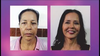 LIFTING FACIAL 👸 REJUVENECIMIENTO FACIAL ANTES y DESPUES 💕CIRUGÍA PLASTICA NEVADO 💜 Dr Percy Nevado [upl. by Pucida]