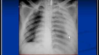 Chest xray interpretation hemothorax [upl. by Fulvia]