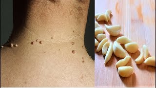 Remove Skin Tags  Home Remedies To Remove Skin Tags Easily [upl. by Katie789]