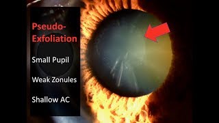 PesudoExfoliation Cataract Surgery Technique including Pupil Stretching [upl. by Cal]