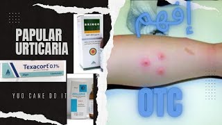 علاج لدغات الحشراتpapular urticaria [upl. by Eigriv333]