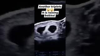 obstetrics ultrasound showing triple gestation healthylifestyle baby viralshorts [upl. by Draper]