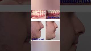 Before and After Orthodontic Treatment dentist bracing music dentalproblem openbite dentistry [upl. by Nenney]