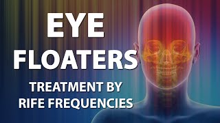 Eye Floaters  RIFE Frequencies Treatment  Energy amp Quantum Medicine with Bioresonance [upl. by Rehsu92]